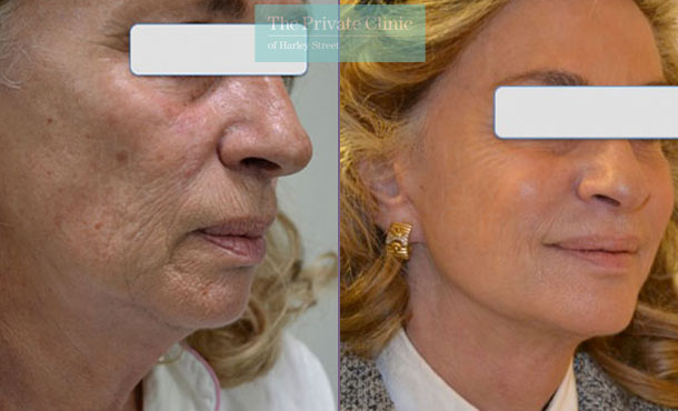 Facelift surgery london before after photos results 094TPC