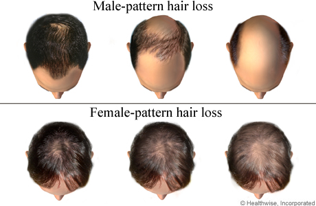 Hair Loss Patterns