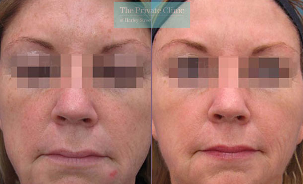 IPL photofacial face before after photo results 029TPC