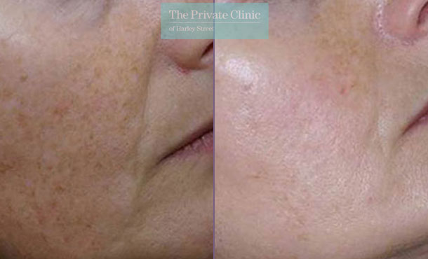 IPL Photorejuvenation - 030TPC