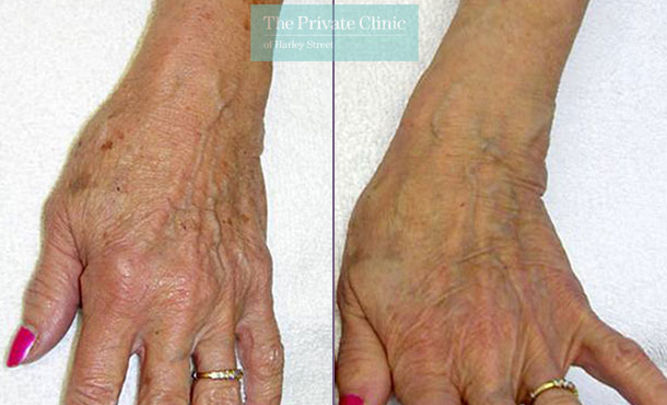 IPL photorejuvenation hands before after photos results 026TPC