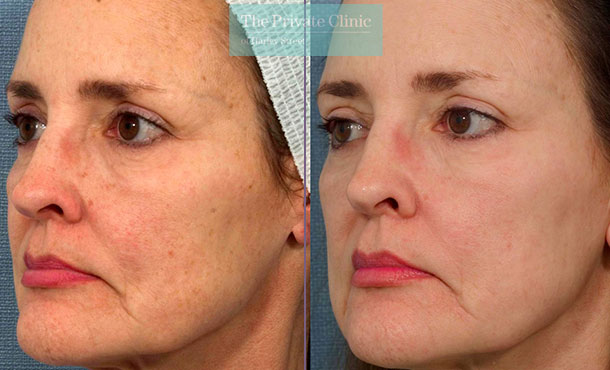 IPL Photorejuvenation - 027TPC