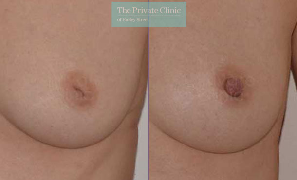 Inverted nipple correction before after photos results front view adrian richards 032AR