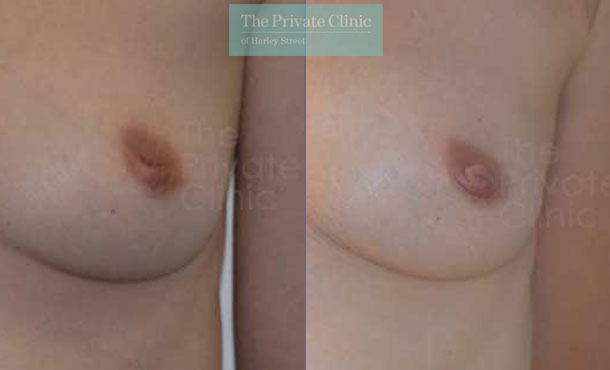 Inverted nipple correction surgery before after photo uk results front adrian richards 033AR