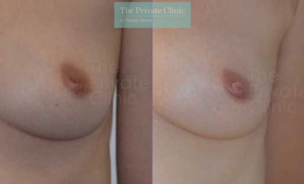 Inverted Nipple Correction - 033AR