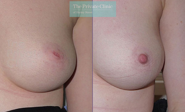 Inverted nipple correction treatment before after photos front miles berry 005MB