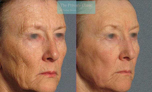 Laser Skin Resurfacing - 045TPC