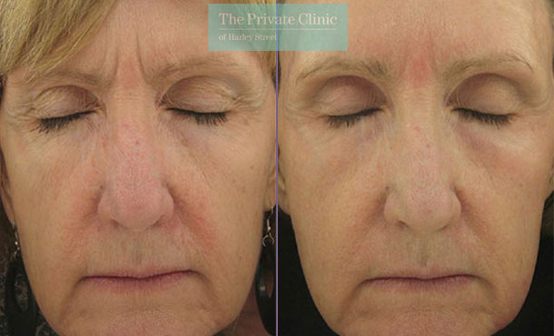 Laser resurfacing facial rejuvenation uk before after photo results 049TPC