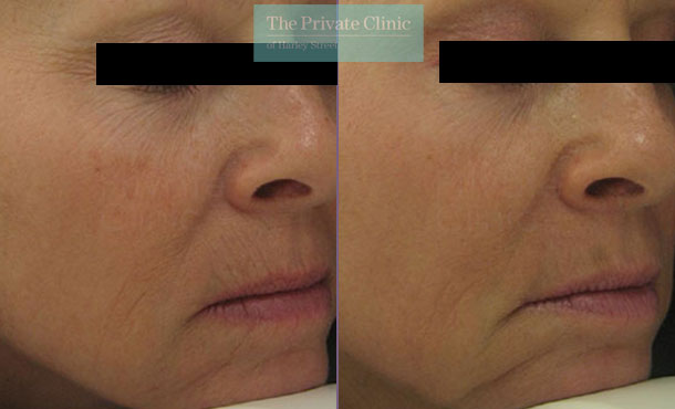 Laser resurfacing nose lips wrinkles before after photos results 043TPC