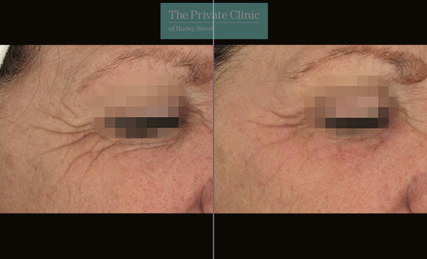 Laser Skin Resurfacing - 060TPC