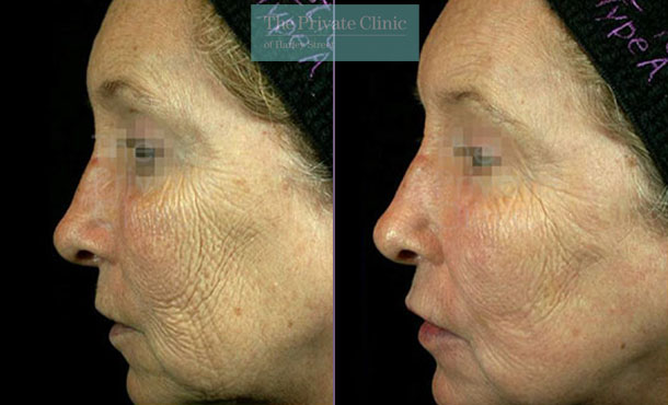 Laser resurfacing pearl crows feet lines before after photo results left side 051TPC