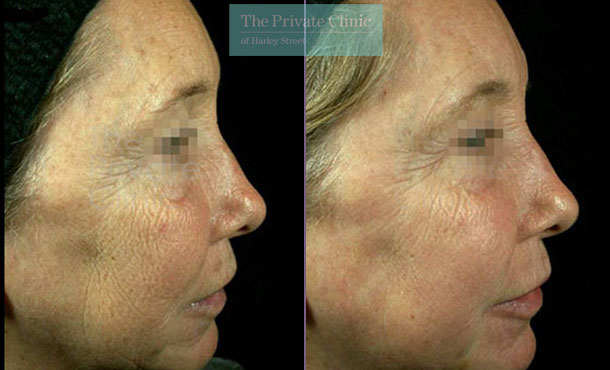 Laser Skin Resurfacing - 051TPC-Right