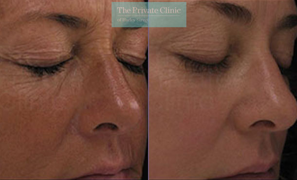 Laser resurfacing pearl eye wrinkles before after photo results 046TPC