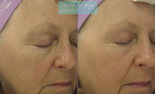 Laser Skin Resurfacing - 050TPC