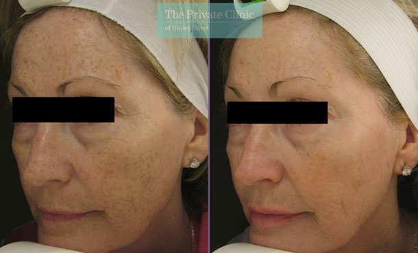 Laser Skin Resurfacing - 040TPC