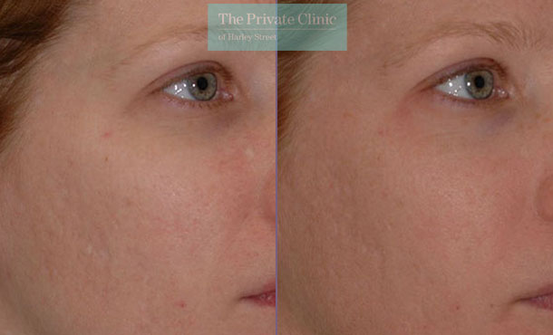 Laser Skin Resurfacing - 066TPC