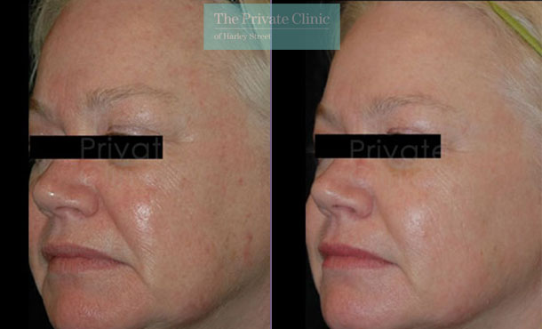 Laser resurfacing pearl face rejuvenation before after results 041TPC