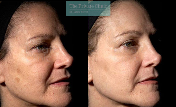 Laser Skin Resurfacing - 038TPC