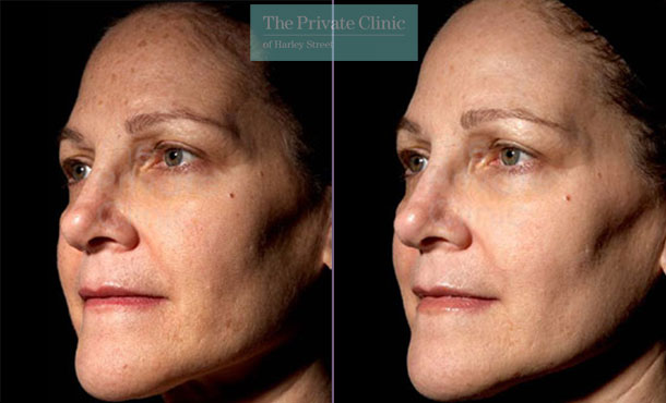 Laser Skin Resurfacing - 039TPC