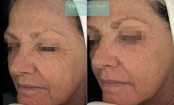 Laser resurfacing pearl face wrinkles lines before after photo results 059TPC