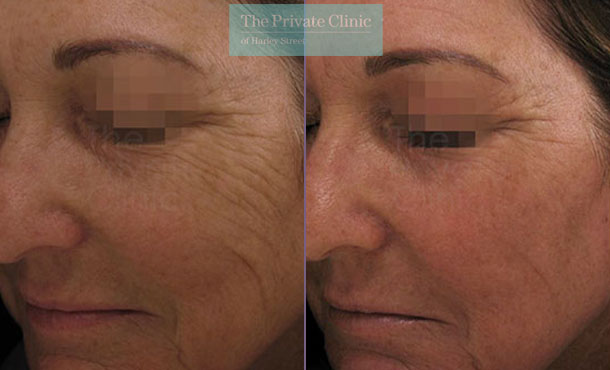 Laser Skin Resurfacing - 061TPC