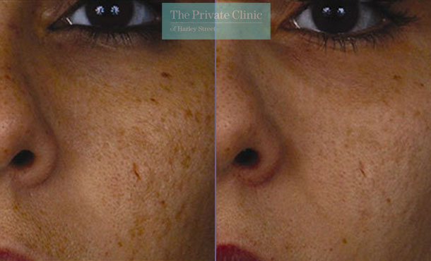 Laser resurfacing pearl facial scarring before after photo results 044TPC