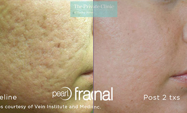 Laser Skin Resurfacing - 065TPC