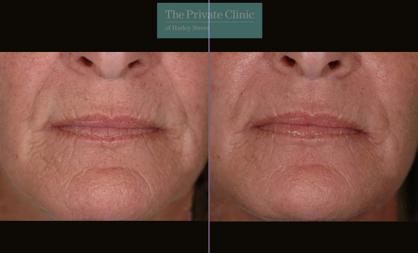 Laser Skin Resurfacing - 067TPC-Front