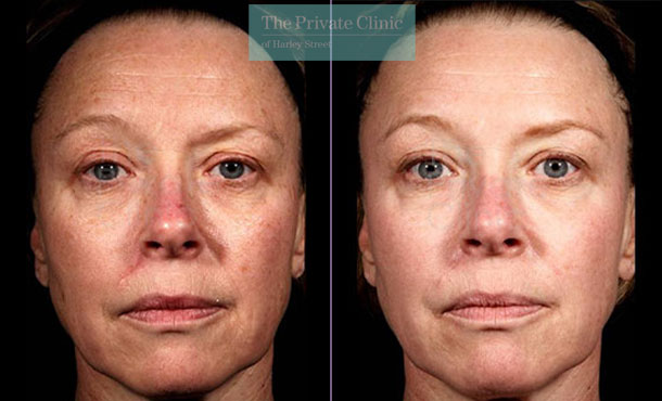 Laser resurfacing pearl london before after photo results 037TPC