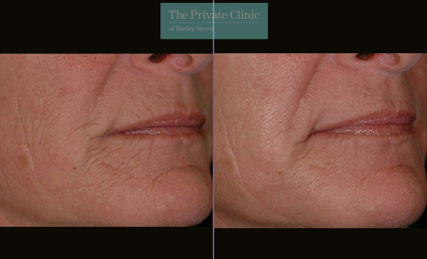 Laser Skin Resurfacing - 067TPC-Side