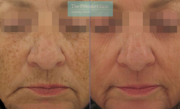 Laser Skin Resurfacing - 055TPC