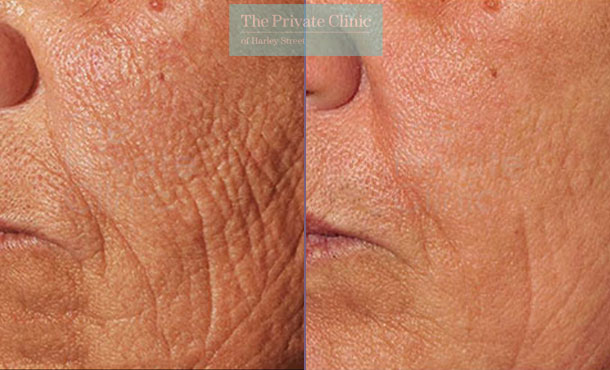 Laser Skin Resurfacing - 064TPC