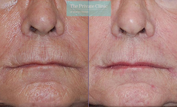 Laser Skin Resurfacing - 054TPC