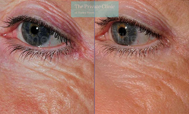 Laser resurfacing pearl under eye wrinkles before after results 062TPC