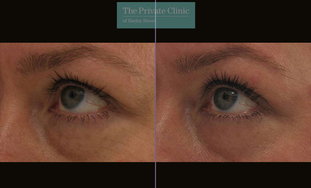 Laser Skin Resurfacing - 058TPC