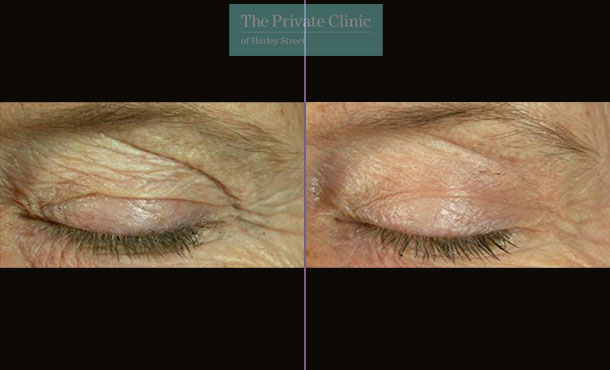 Laser Skin Resurfacing - 052TPC