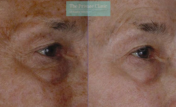 Laser resurfacing pearl upper lower eyelids eyebag before after photo results 042TPC