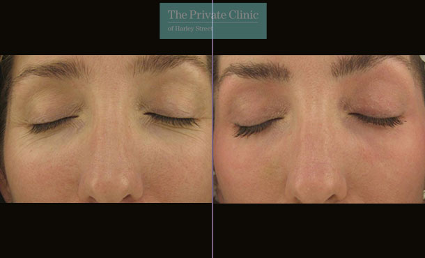 Laser Skin Resurfacing - 048TPC