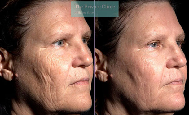 Laser Skin Resurfacing - 047TPC