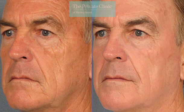 Laser Skin Resurfacing - 057TPC