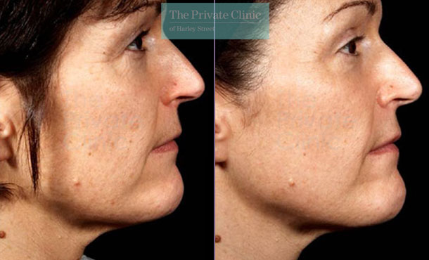 Laser skin resurfacing pearl before after photo results 036TPC