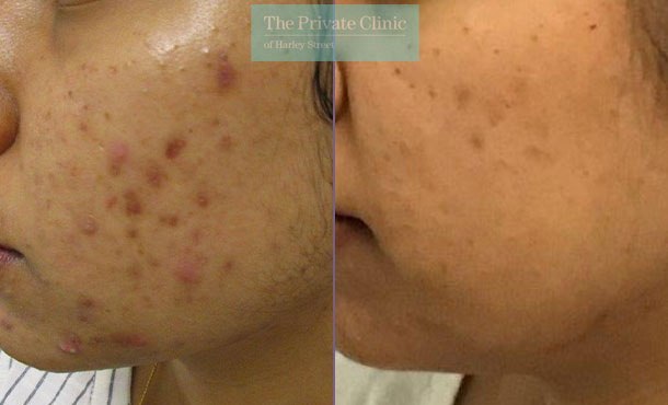 N Lite treatment for acne before after results 019TPC
