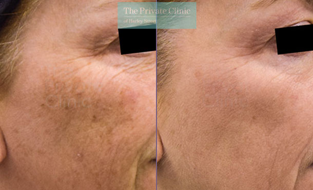 Obagi NuDerm skincare uk before after photo results 073TPC