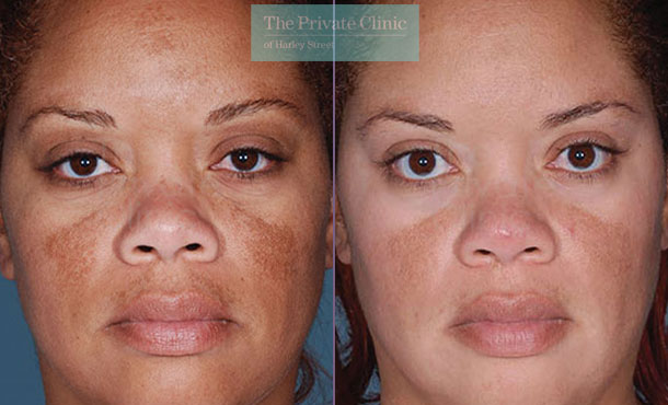 Obagi NuDerm system results before after photos 076TPC