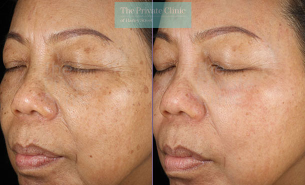 Obagi NuDerm system skin rejuvenation before after photo results 080TPC