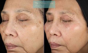 Obagi NuDerm system uk results before after 078TPC