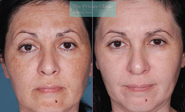 Obagi NuDerm update before after photo results 077TPC