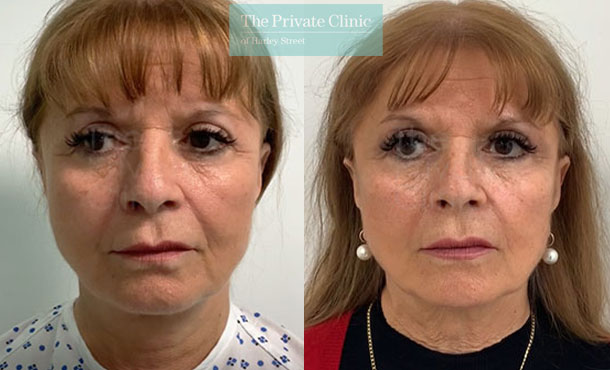 One stitch lift temporal facelift london before after photos results front davood fallahdar 016DF