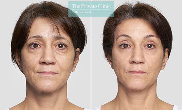 Threadlift mid face lift eyebrows surgery before after photo results 083TPC