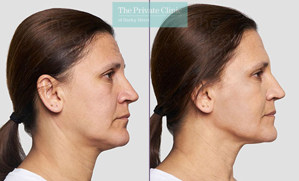 Threadlift mid face lift jawline female before after photo uk results 084TPC